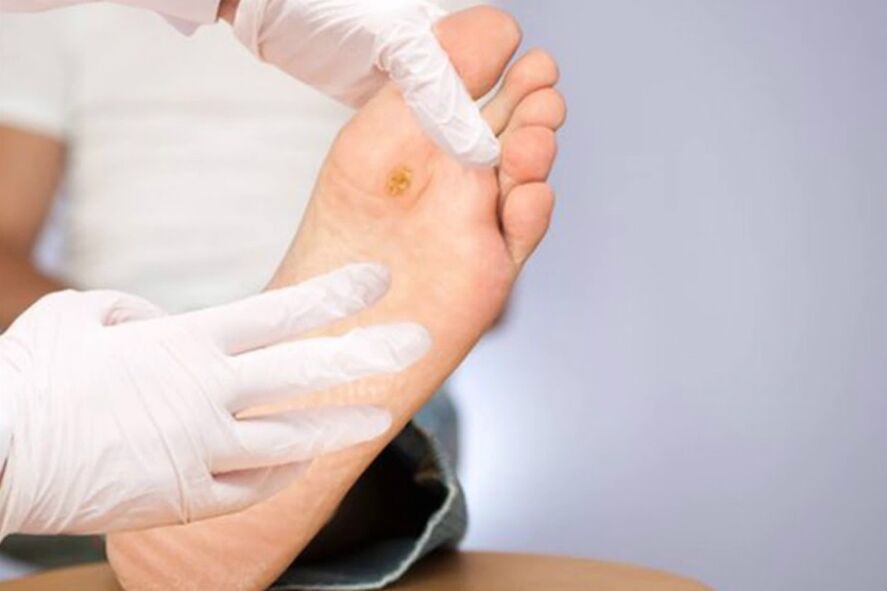 Pie diabético complicación severa de la diabetes